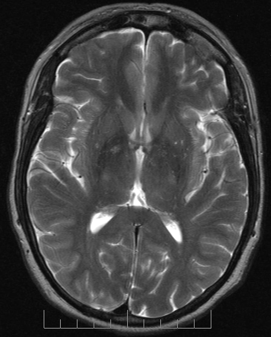 뇌 MRI T2 Axial 영상